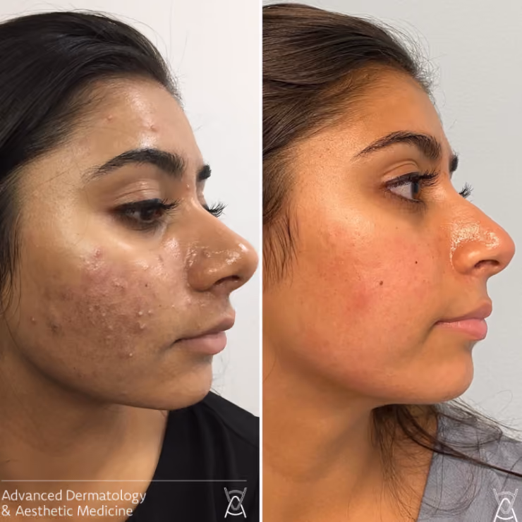 Acne Scar Laser Treatment: Revolutionary Technology for Smooth, Clear Skin