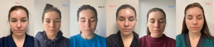 Chemical Peel Before and After: What Real Results Look Like and When to Expect Them