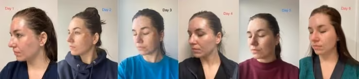 Chemical Peel Near Me: Your Complete Guide to Professional skin rejuvenation in Chicago