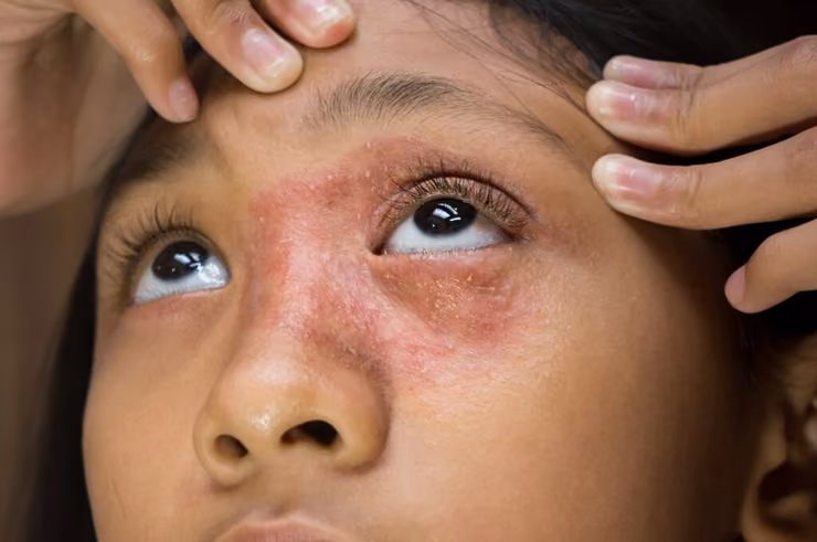 What Is Eczema and How Is It Treated?
