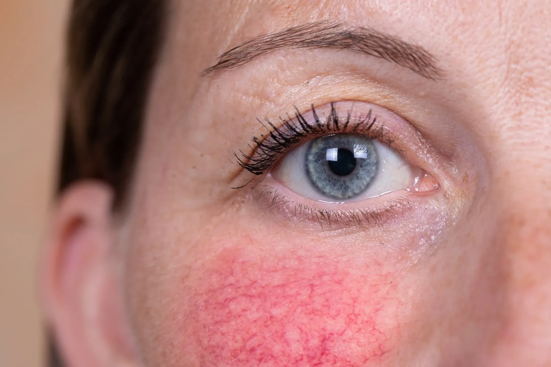 Close-up of a woman's cheek with redness and small visible blood vessels