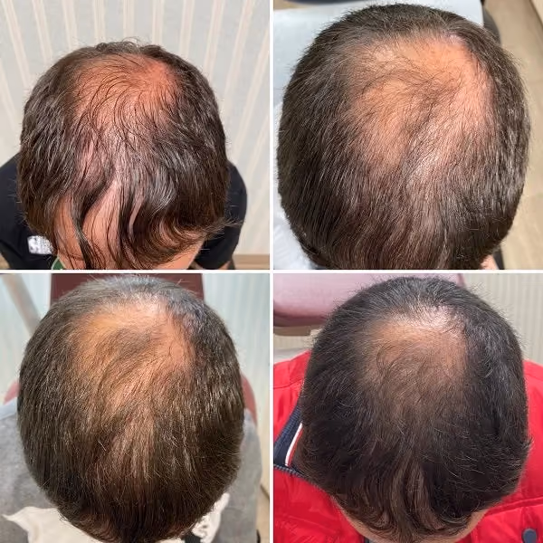 PRP for Hair Loss: How This Revolutionary Treatment Stimulates Natural Hair Regrowth