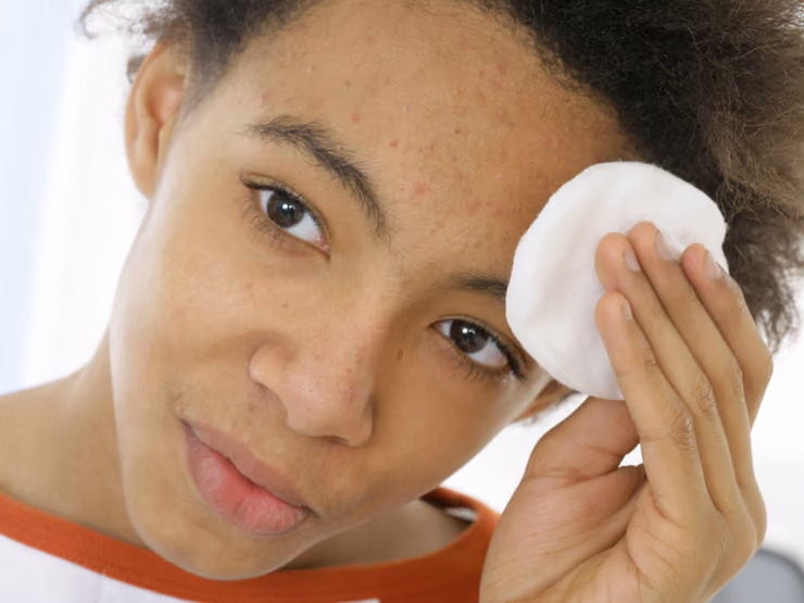 The 411 on Acne: Causes, Treatments and Quick Tips