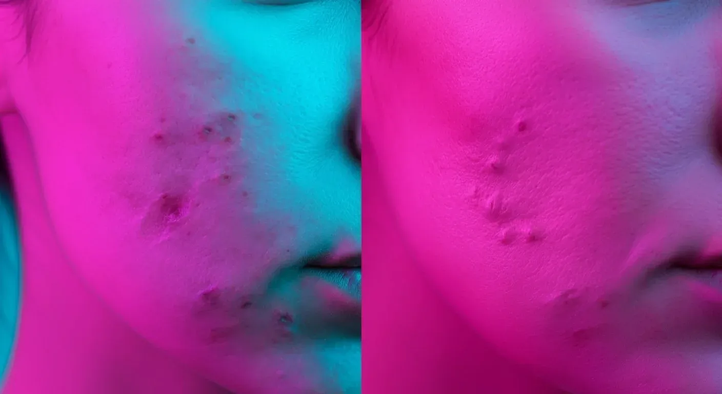 Illustration of two cheek close-ups in pink and teal light, showing acne marks and bumps