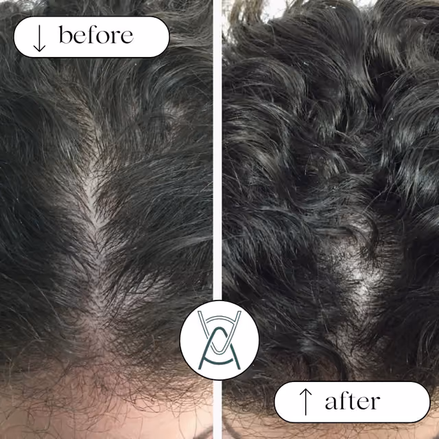 PRP Hair Treatment Before After: Real Transformations and What to Expect