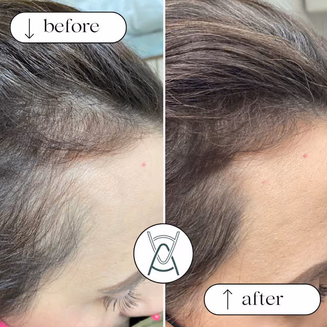 PRP for Hair Loss: Your Complete Guide to Platelet-Rich Plasma Hair Restoration