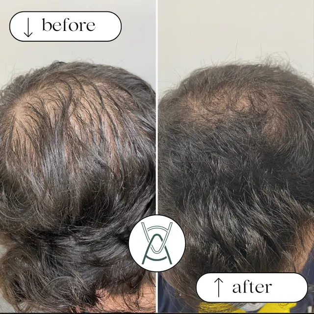Before-and-after photos of thinning hair on the crown of the head, treated with PRP
