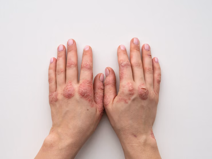 Psoriasis Awareness Month