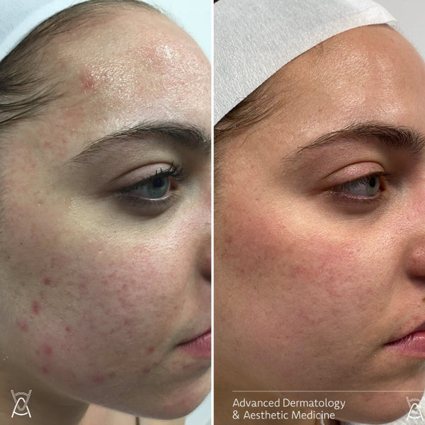 MICRONEEDLING