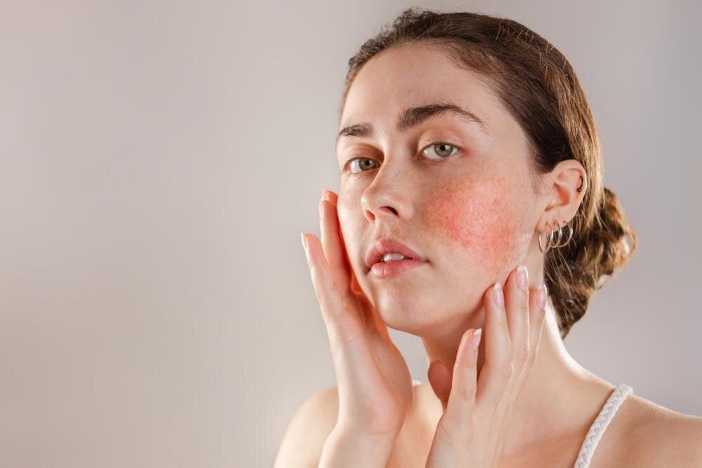 Is My Face Just Red or Do I have Rosacea?