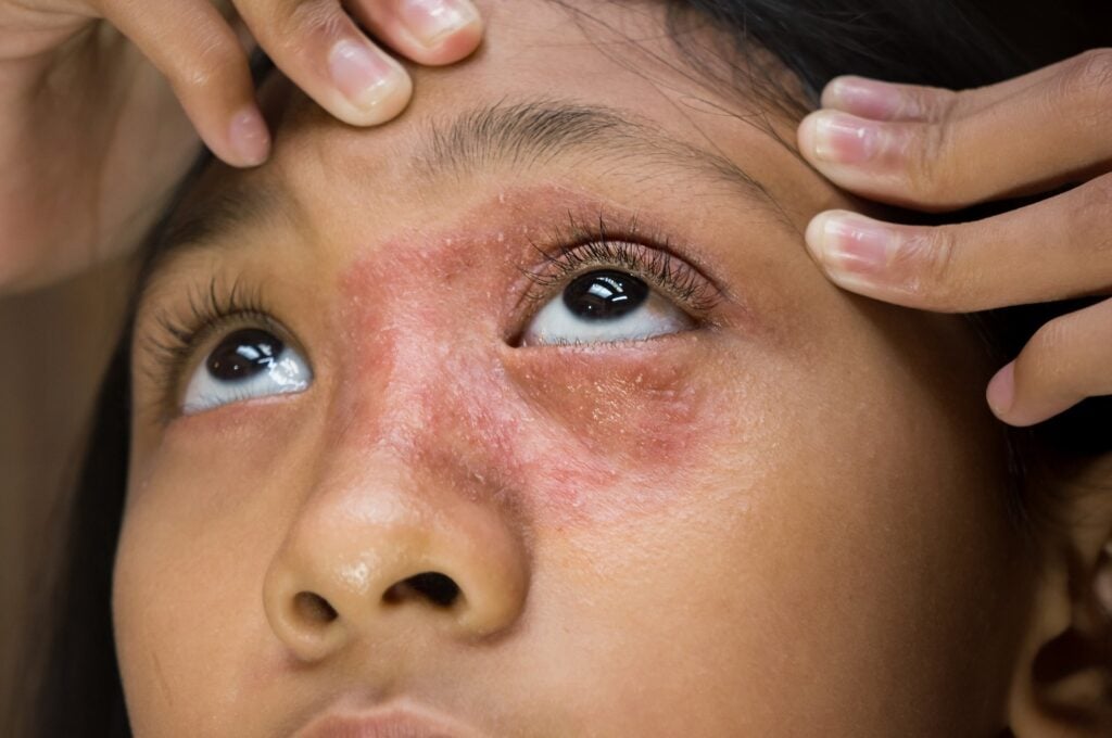What is Eczema?