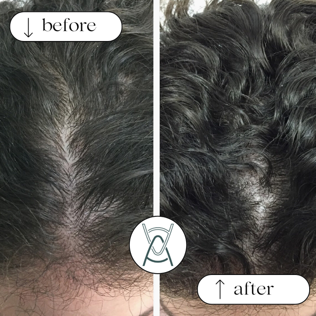 Hair Loss PRP Injection: Revolutionary Treatment for Natural Hair Restoration