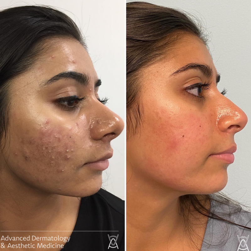 Acne Scar Laser Treatment: Revolutionary Technology for Smooth, Clear Skin