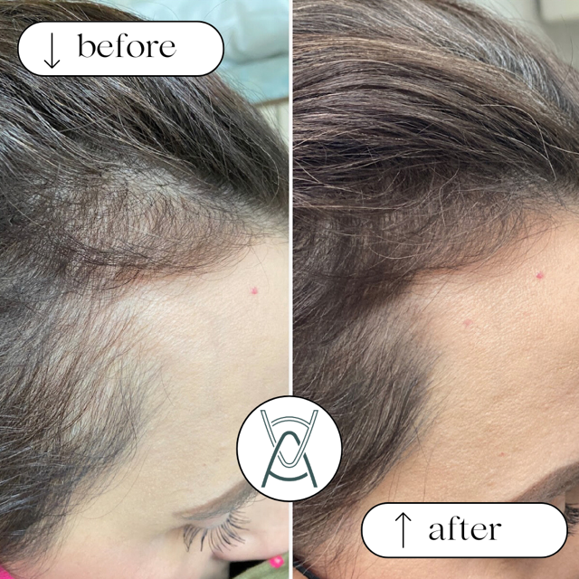PRP for Hair Loss: Your Complete Guide to Platelet-Rich Plasma Hair Restoration