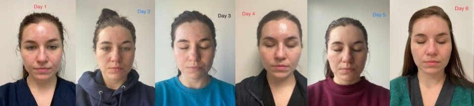 Chemical Peel Near Me: Your Complete Guide to Professional Skin Rejuvenation in Chicago