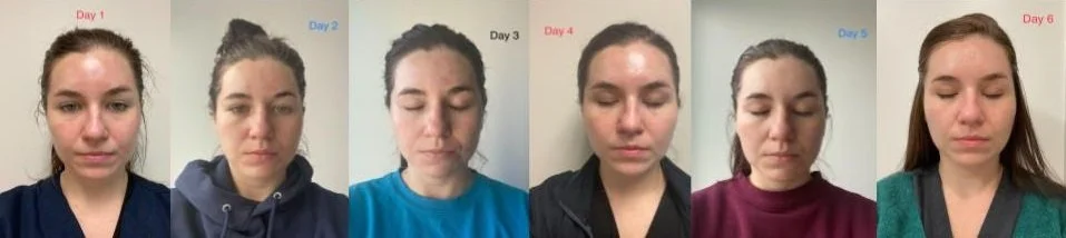 Chemical Peel Before and After: What Real Results Look Like and When to Expect Them