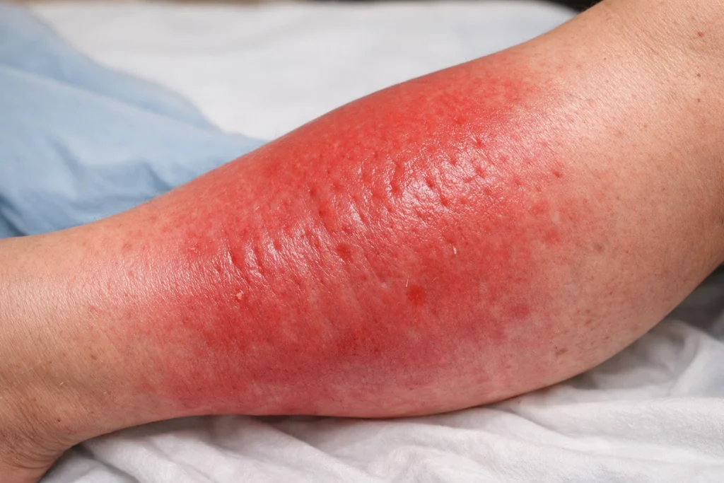 Cellulitis Specialists Chicago: Expert Treatment & Care | Advanced Derm
