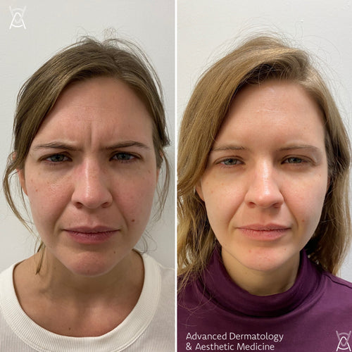 Botox or Dysport before and after photos, frown lines between the brows, case 2