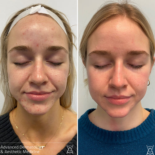 Acne treatment before and after photos, face, case 15