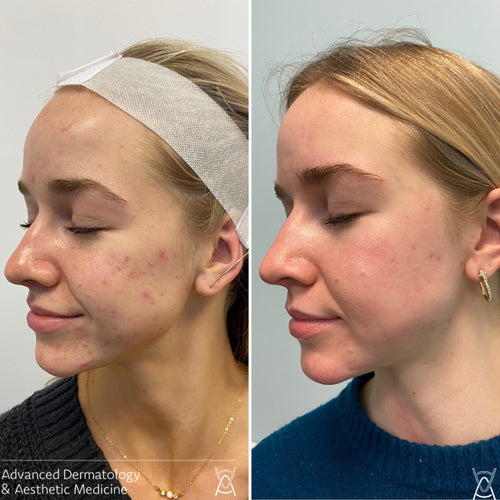 Acne treatment before and after photos, cheek and jawline, case 16