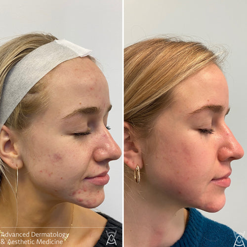Acne treatment before and after photos, cheek and jawline, case 17