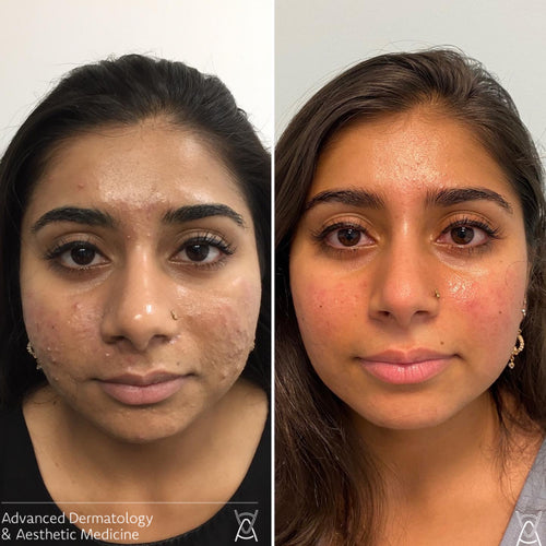 Acne treatment before and after photos, cheeks, case 12