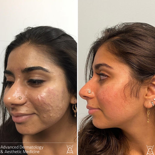Acne treatment before and after photos, cheek, case 13