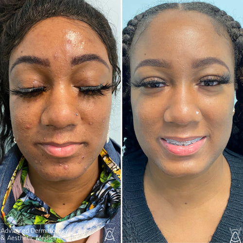 Acne treatment before and after photos, face, case 18
