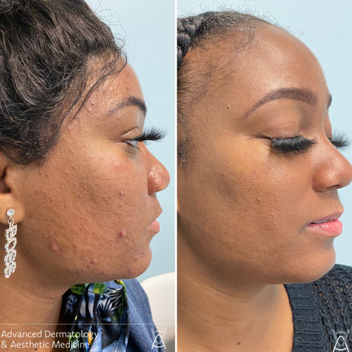 Acne treatment before and after photos, cheek and jawline, case 20