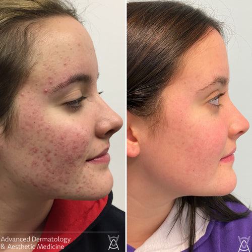 Acne treatment before and after photos, cheek, case 19