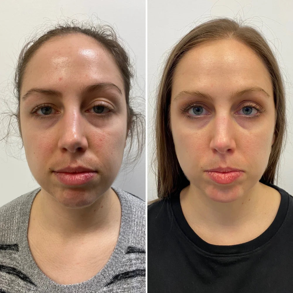 Laser treatment before and after photos, face, case 55
