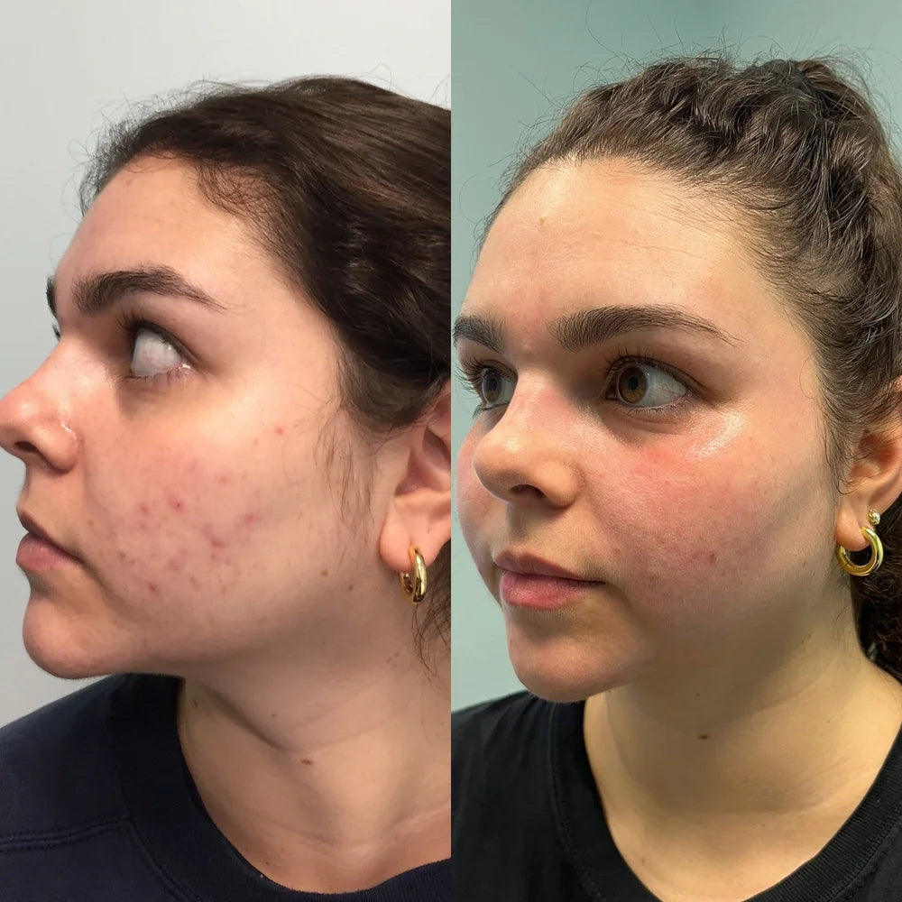 Laser treatment before and after photos, cheek, case 56