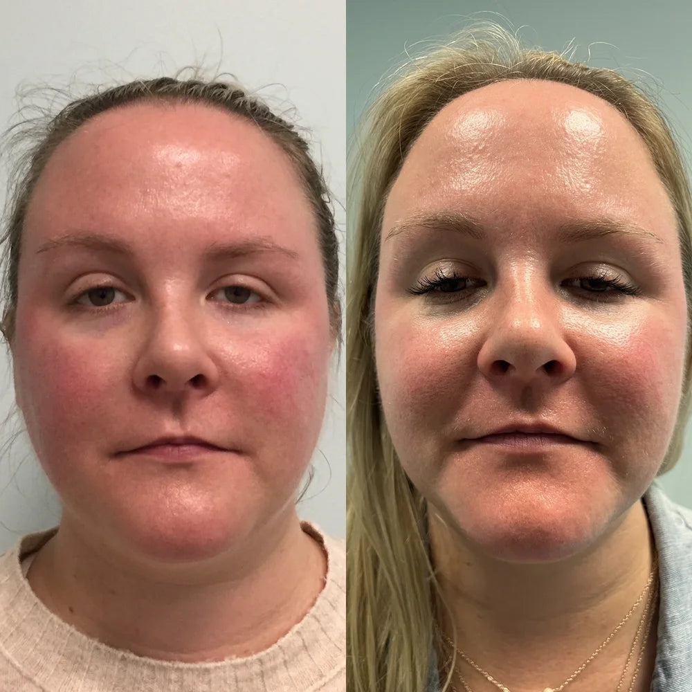 Laser treatment before and after photos, cheeks, case 54