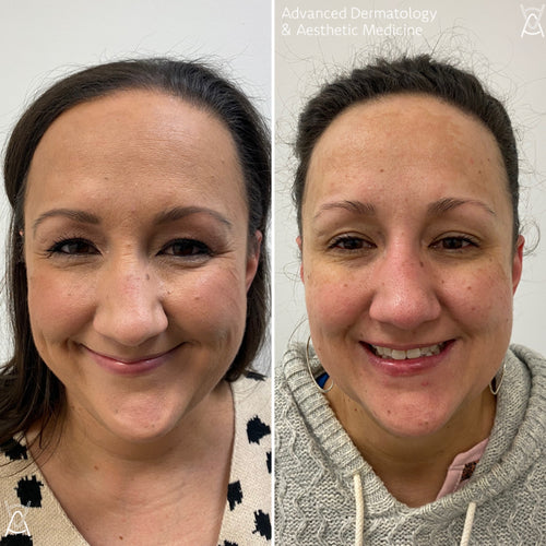 Botox or Dysport before and after photos, crow's feet, case 10