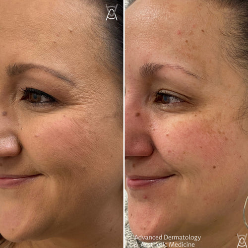 Botox or Dysport before and after photos, crow's feet, case 44