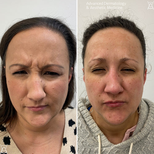 Botox or Dysport before and after photos, frown lines between the brows, case 11