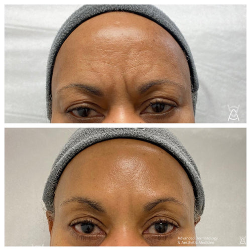 Botox or Dysport before and after photos, frown lines between the brows, case 6