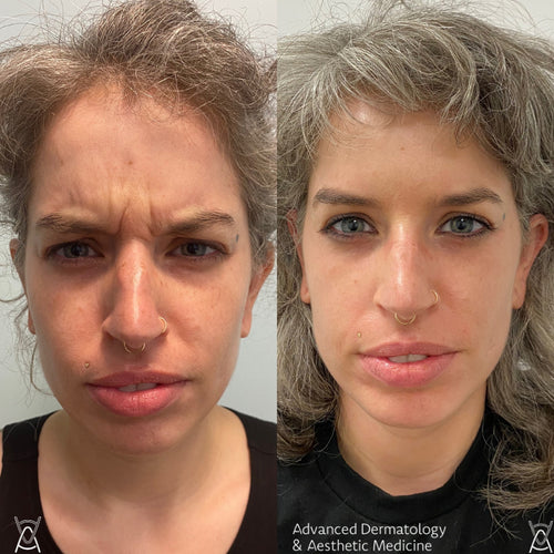 Botox or Dysport before and after photos, frown lines between the brows, case 3
