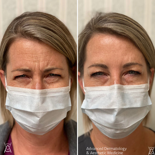 Botox or Dysport before and after photos, frown lines between the brows, case 8