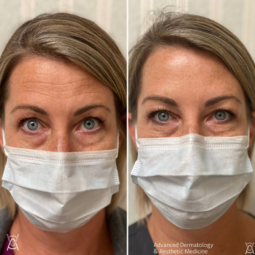 Botox or Dysport before and after photos, forehead lines, case 9