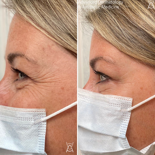 Botox or Dysport before and after photos, crow's feet, case 7