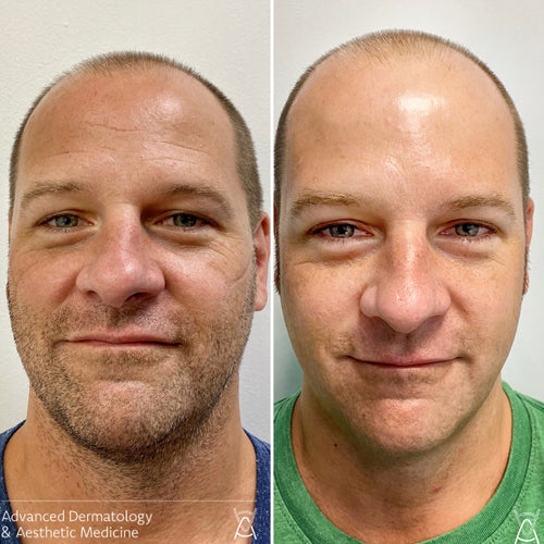 Botox or Dysport before and after photos, forehead lines, case 4