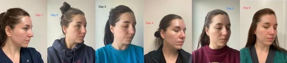 Chemical peel before and after photos, face, case 47
