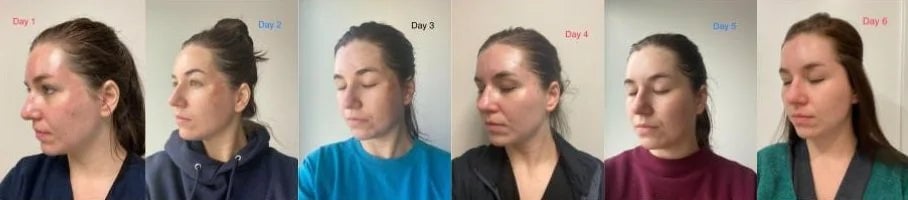 Chemical Peel Near Me: Your Complete Guide to Professional skin rejuvenation in Chicago