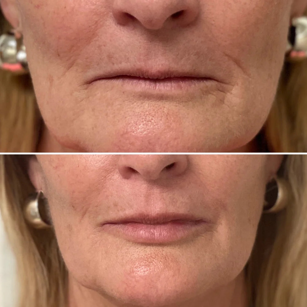 Dermal filler before and after photos, around the mouth, case 57