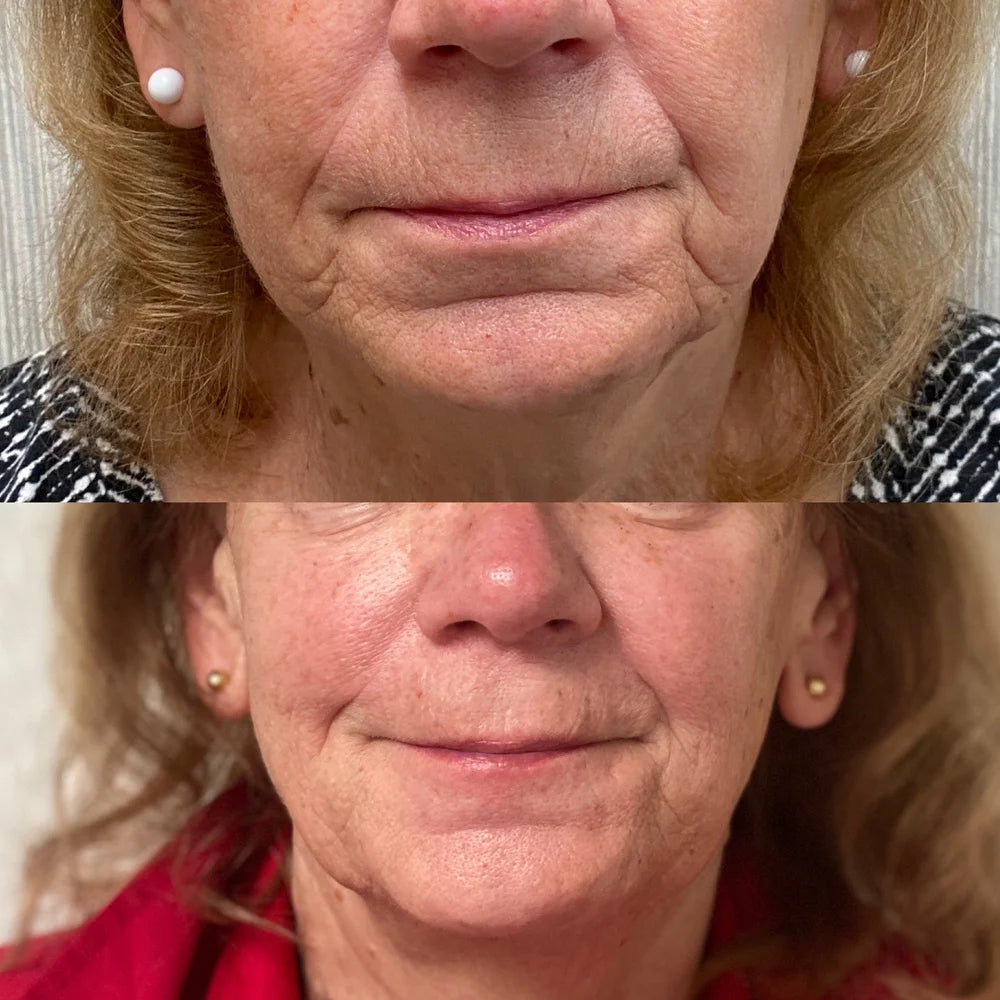 Dermal filler before and after photos, around the mouth, case 58