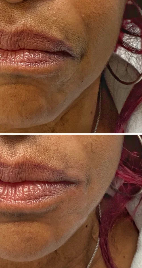 Dermal filler before and after photos, lips, case 59