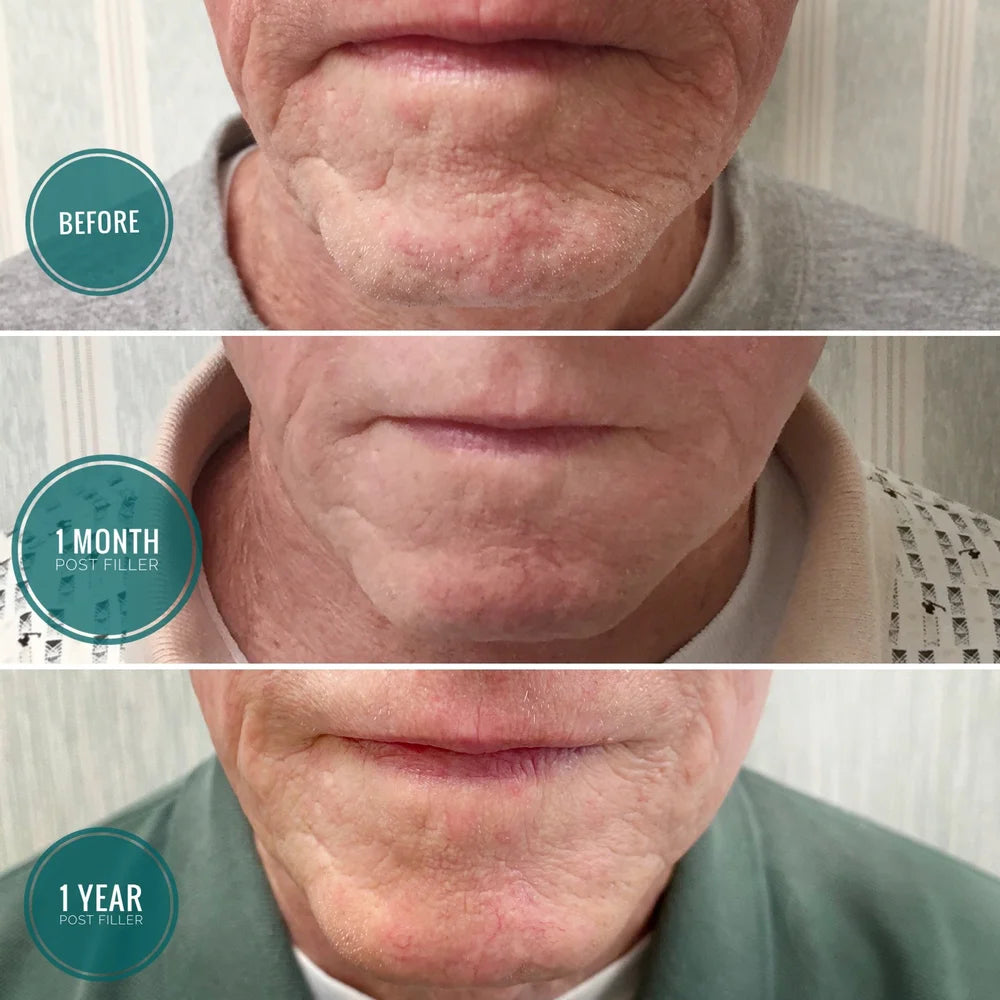 Dermal filler before and after photos, chin, case 60