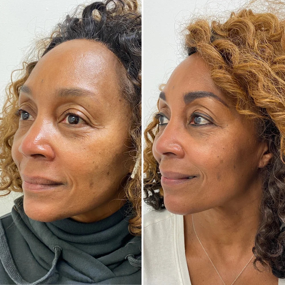 Dermal filler before and after photos, cheek and under-eye area, case 61