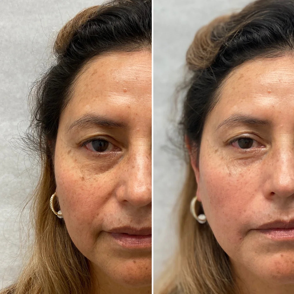 Dermal filler before and after photos, under-eye area, case 62
